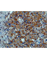 Immunohistochemical staining of formalin fixed and paraffin embedded melanoma tissue sections.