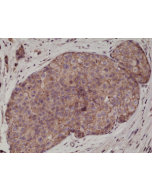 Immunohistochemical staining of formalin fixed and paraffin embedded human breast cancer tissue sections using Anti-E-cadherin RM244 at a 1:1000 dilution.