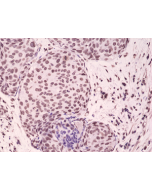 Immunohistochemical staining of formalin fixed and paraffin embedded human breast cancer tissue sections using Anti-Phospho-p38 MAPK (Thr180/Tyr182) RM243 at a 1:1000 dilution.