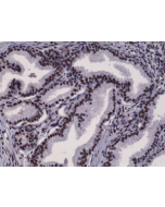Immunohistochemical staining of formalin fixed and paraffin embedded human prostate cancer tissue section using anti-Androgen Receptor (N-term) rabbit monoclonal antibody (Clone RM254) at a 1:2500 dilution.