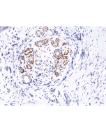 Immunohistochemical staining of formalin fixed and paraffin embedded human breast cancer tissue sections using Anti-Phospho-Stat3 (Tyr705) Rabbit Monoclonal Antibody (clone RM261) at a 1:10,000 dilution.