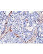 Immunohistochemical staining of formalin fixed and paraffin embedded human prostate cancer sections using Anti-PTEN RM265 at a 1:2000 dilution.