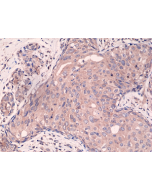 Immunohistochemical staining of formalin fixed and paraffin embedded human breast cancer tissue sections using Anti-Smad4 Rabbit Monoclonal Antibody (Clone RM277) at a 1:2000 dilution.