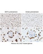 Immunostaining of brain tumor tissue sections using both EDTA and Citrate pretreatment methods. Clinically validated to be Positive for the H3.3 K27M Mutation by Sanger sequencing. Image courtesy of Sebastian Brandner MD, Division of Neuropathology and De