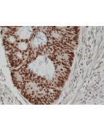 Immunohistochemical staining of formalin fixed and paraffin embedded human colon cancer tissue section using anti-MSH2 rabbit monoclonal antibody (Clone RM375) at a 1:200 dilution.