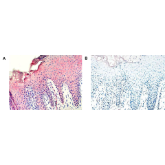 Immunohistochemical staining of vaspin with anti-Vaspin (human), mAb (VP63) (AG-20A-0045) in psoriatic skin lesions (A). Negative control for vaspin in psoriatic skin lesions (B). Blue hematoxylin stained cell nuclei.