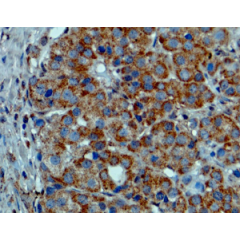 Immunohistochemical staining of formalin fixed and paraffin embedded melanoma tissue sections.