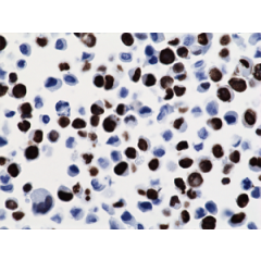 Immunohistochemical staining of formalin fixed and paraffin embedded 293T cells transfected with a DNA construct encoding Histone H3 K36M, stained with anti-Histone H3 K36M clone RM193.