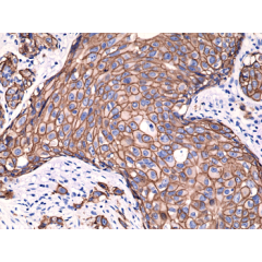 Immunohistochemical staining of FFPE humanbreast cancer tissue sections, using Anti-HER2 (c-erbB-2) Rabbit Monoclonal antibody RM228.