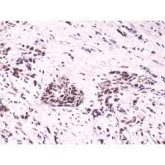 Immunohistochemical staining of formalin fixed and paraffin embedded human breast cancer tissue sections using Anti-HIF-1-alpha RM242 at a 1:1000 dilution.