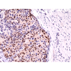 Immunohistochemical staining of formalin fixed and paraffin embedded human breast cancer tissue sections using Anti-Cyclin D1 RM241 at a 1:1000 dilution.