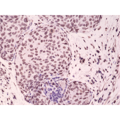 Immunohistochemical staining of formalin fixed and paraffin embedded human breast cancer tissue sections using Anti-Phospho-p38 MAPK (Thr180/Tyr182) RM243 at a 1:1000 dilution.