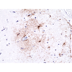 Immunohistochemical staining of formalin fixed and paraffin embedded human brain tissue sections using Anti-GFAP RM246 at a 1:500 dilution.