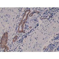 Immunohistochemical staining of formalin fixed and paraffin embedded human breast cancer tissue sections using Anti-CD146 RM249 at a 1:400 dilution.