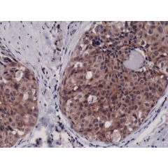 Immunohistochemical staining of formalin fixed and paraffin embedded human breast cancer tissue sections using Anti-Caspase-3 RM250 at a 1:2500 dilution.