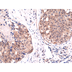 Immunohistochemical staining of formalin fixed and paraffin embedded human breast cancer tissue sections using Anti-Akt1 RM252 at a 1:1000 dilution.