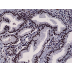 Immunohistochemical staining of formalin fixed and paraffin embedded human prostate cancer tissue section using anti-Androgen Receptor (N-term) rabbit monoclonal antibody (Clone RM254) at a 1:2500 dilution.