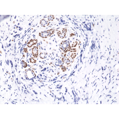 Immunohistochemical staining of formalin fixed and paraffin embedded human breast cancer tissue sections using Anti-Phospho-Stat3 (Tyr705) Rabbit Monoclonal Antibody (clone RM261) at a 1:10,000 dilution.