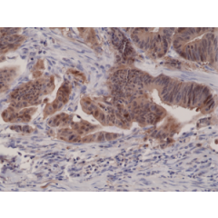 Immunohistochemical staining of formalin fixed and paraffin embedded human colon cancer tissue sections using Anti-p16INK4a RM267 at a 1:1000 dilution.