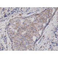 Immunohistochemical staining of formalin fixed and paraffin embedded human breast cancer tissue sections using Anti-CD44 Rabbit Monoclonal Antibody (Clone RM264) at a 1:5000 dilution.