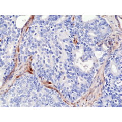 Immunohistochemical staining of formalin fixed and paraffin embedded human prostate cancer sections using Anti-PTEN RM265 at a 1:2000 dilution.