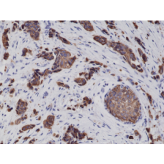 Immunohistochemical staining of formalin fixed and paraffin embedded human breast cancer tissue sections using Anti-CK8 Rabbit Monoclonal Antibody (Clone RM266) at a 1:2000 dilution.