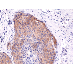 Immunohistochemical staining of formalin fixed and paraffin embedded human breast cancer tissue sections using Anti-Phospho-Acetyl CoA Carboxylase (Ser79) Rabbit Monoclonal Antibody (clone RM270) at a 1:5000 dilution.