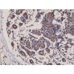 Immunohistochemical staining of formalin fixed and paraffin embedded human breast cancer tissue sections using Anti-Smac/Diablo Rabbit Monoclonal Antibody (Clone RM271) at a 1:1000 dilution.