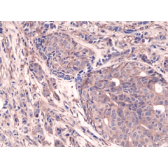 Immunohistochemical staining of formalin fixed and paraffin embedded human breast cancer tissue sections using Anti-NFkB p65 Rabbit Monoclonal Antibody (Clone RM273) at a 1:1250 dilution.