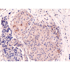 Immunohistochemical staining of formalin fixed and paraffin embedded human breast cancer tissue sections using Anti-mTOR Rabbit Monoclonal Antibody (Clone RM274) at a 1:1000 dilution.