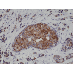 Immunohistochemical staining of formalin fixed and paraffin embedded human breast cancer tissue sections using Anti-CK18 Rabbit Monoclonal Antibody (Clone RM279) at a 1:4000 dilution.