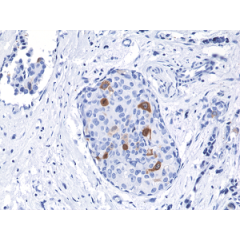 Immunohistochemical staining of formalin fixed and paraffin embedded human breast cancer tissue sections using Anti-Cyclin B1 RM281 at a 1:2000 dilution.