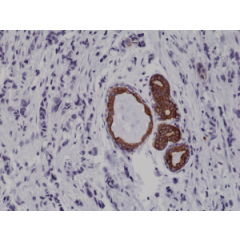 Immunohistochemical staining of formalin fixed and paraffin embedded human breast cancer tissue sections using Anti-CK7 Rabbit Monoclonal Antibody (Clone 284) at a 1:1000 dilution.