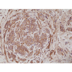 Immunohistochemical staining of formalin fixed and paraffin embedded human breast cancer tissue sections using anti-alpha-Actinin 4 rabbit monoclonal antibody (clone RM287) at a 1:200 dilution.