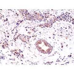 Immunohistochemical staining of formalin fixed and paraffin embedded human breast cancer tissue sections using anti-EGF Receptor rabbit monoclonal antibody (clone RM294) at a 1:200 dilution.
