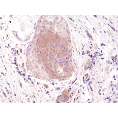 Immunohistochemical staining of formalin fixed and paraffin embedded human breast cancer tissue section using anti-phospho-eIF-2α (Ser51) rabbit monoclonal antibody (clone RM298) at a 1:200 dilution.