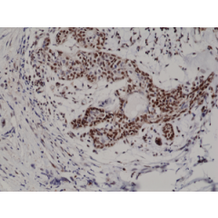 Immunohistochemical staining of formalin fixed and paraffin embedded human breast cancer tissue section using anti-p27Kip1 rabbit monoclonal antibody (clone RM302) at a 1:200 dilution.