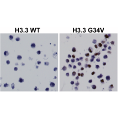 Immunohistochemical staining of formalin fixed and paraffin embedded 293T cells transfected with a DNA construct encoding Histone H3.3 wild type or G34V mutant, stained with anti-Histone H3.3 G34V rabbit monoclonal antibody (clone RM307).