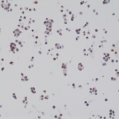 Immunohistochemical staining of formalin fixed and paraffin embedded 22RV1 cell section using anti-BAG-1L rabbit monoclonal antibody (Clone RM310) at a 1:2000 dilution.