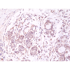 Immunohistochemical staining of formalin fixed and paraffin embedded human breast cancer tissue section using anti-AKT (PH domain) rabbit monoclonal antibody (Clone RM316) at a 1:500 dilution.