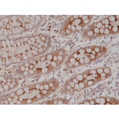 Immunohistochemical staining of formalin fixed and paraffin embedded human colon tissue section using anti-CEA rabbit monoclonal antibody (Clone RM326) at a 1:2000 dilution.