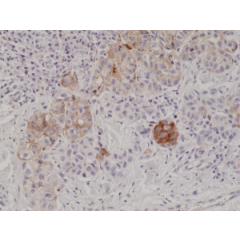 Immunohistochemical staining of formalin fixed and paraffin embedded human melanoma tissue section using anti-MART1 rabbit monoclonal antibody (Clone RM333) at a 1:1000 dilution.