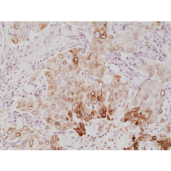 Immunohistochemical staining of formalin fixed and paraffin embedded human lung cancer tissue section using anti-COX-2 rabbit monoclonal antibody (Clone RM348) at a 1:1000 dilution.