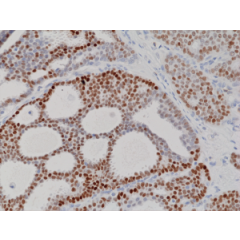 Immunohistochemical staining of formalin fixed and paraffin embedded human breast cancer tissue sections using Anti-Progesterone Receptor (PR) Rabbit Monoclonal Antibody (Clone RM357) at a 1:100 dilution.