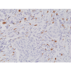 Immunohistochemical staining of formalin fixed and paraffin embedded human lung cancer tissue section using anti-CD117/c-Kit rabbit monoclonal antibody (Clone RM359) at a 1:2000 dilution.