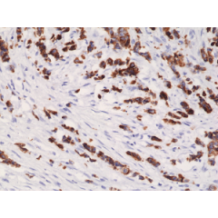 Immunohistochemical staining of formalin fixed and paraffin embedded human breast cancer tissue section using anti-CK-19 rabbit monoclonal antibody (Clone RM364) at a 1:1000 dilution.