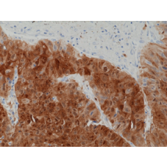 Immunohistochemical staining of formalin fixed and paraffin embedded human liver cancer tissue section using anti-ARG1 rabbit monoclonal antibody (Clone RM377) at a 1:1250 dilution.