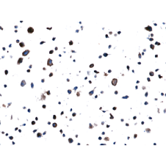 Immunohistochemical staining of formalin fixed and paraffin embedded H1975 cell section using Anti-EGFR(L858R) Rabbit Monoclonal Antibody (Clone RM380) at a 1:100 dilution.