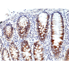 Immunohistochemical staining of formalin fixed and paraffin embedded human colon cancer tissue section using anti-CD71 rabbit monoclonal antibody (Clone RM384) at a 1:500 dilution.