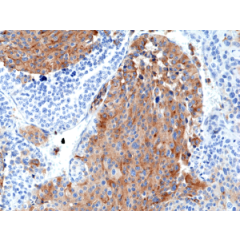 Immunohistochemical staining of formalin fixed and paraffin embedded Medullary Thyroid Carcinoma tissue section using anti-Chromogranin A rabbit monoclonal antibody (Clone RM385) at a 1:2500 dilution.